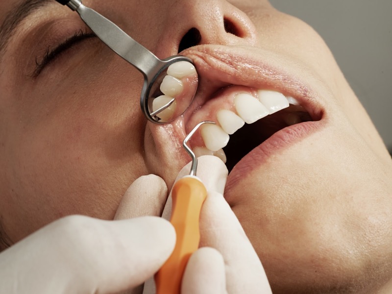EMS AirFlow dental cleaning